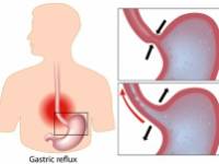 10 hatásos otthoni gyógymód a savas reflux és a gyomorégés kezelésére