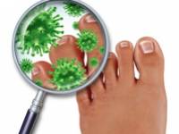 A lábgomba kezelésének hatékony otthoni gyógymódjai