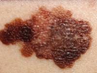 Bőrrák: a meglévő vagy az új anyajegyektől kell jobban tartani?