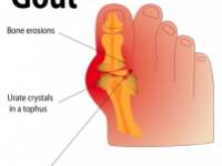 Hogyan csökkentsük természetes módon vérünk húgysavszintjét?