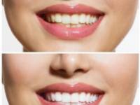 Otthoni gyógymódok az ínyduzzadás megszüntetésére