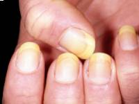 Sárga köröm szindróma: tünetek, okok és kezelés