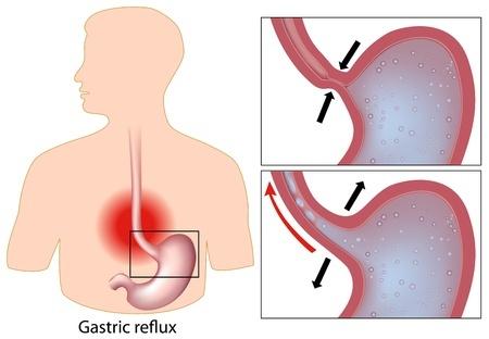 10 hatásos otthoni gyógymód a savas reflux és a gyomorégés kezelésére