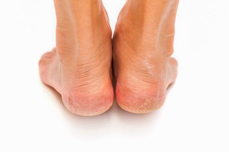 Fáj a sarka? Természetes megoldást keres?